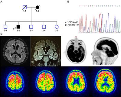 Novel heterozygous mutation in alpha-2-macroglobulin (A2M) suppressing the binding of amyloid-β (Aβ)